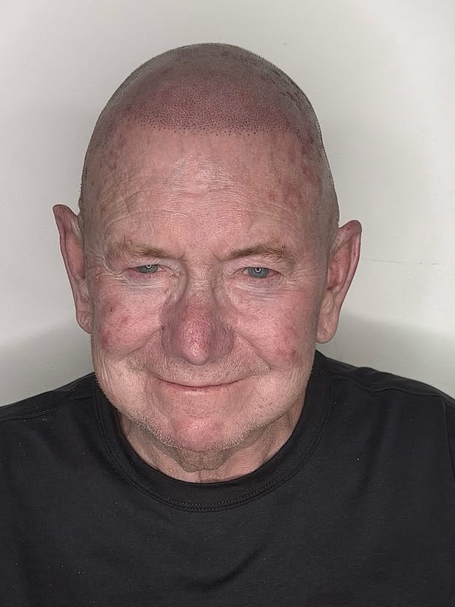 Happy SMP by Jack client giving two thumbs up after completed scalp micropigmentation treatment